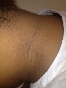 Acanthosis