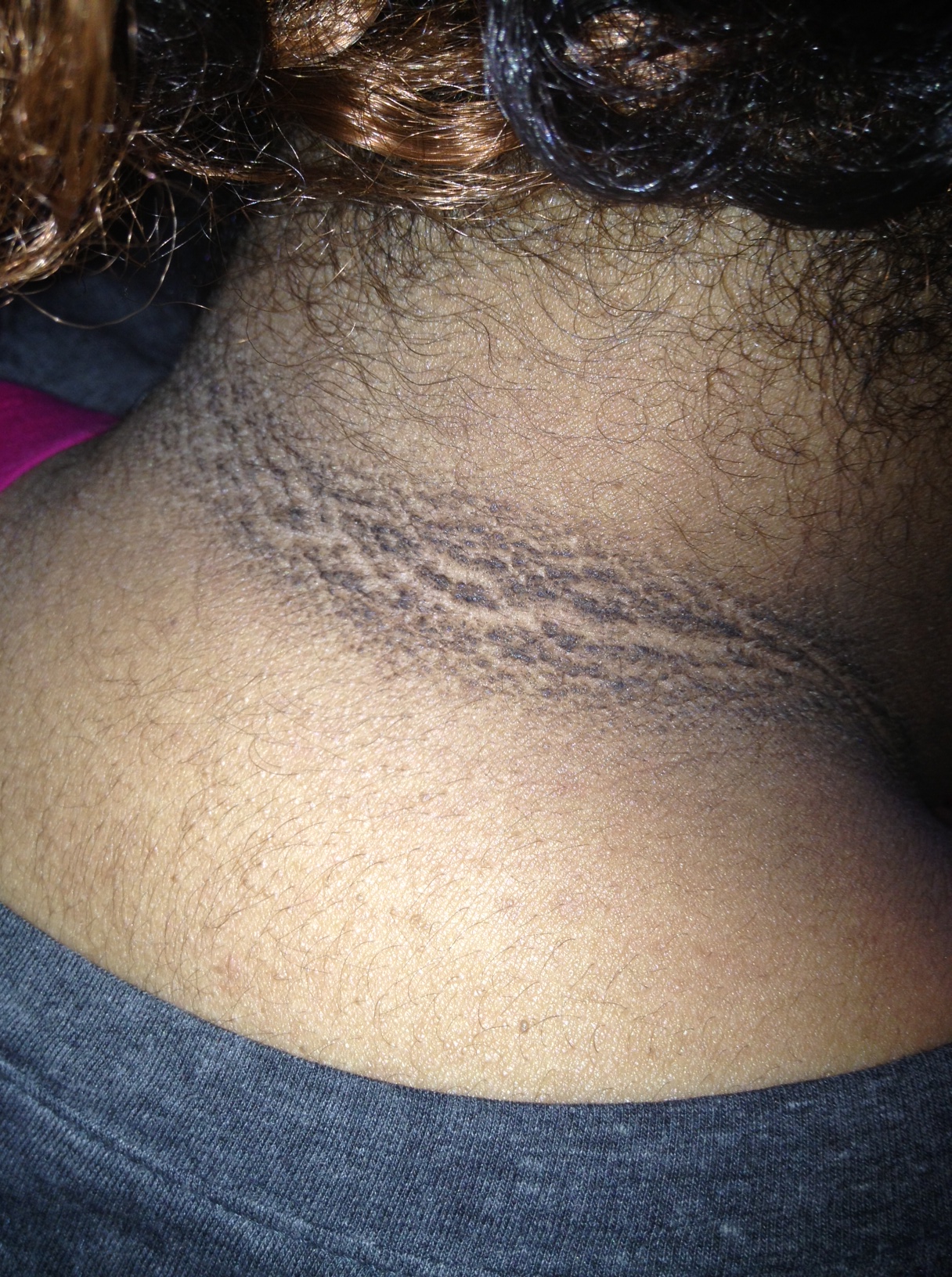 Acanthosis nigricans of the neck