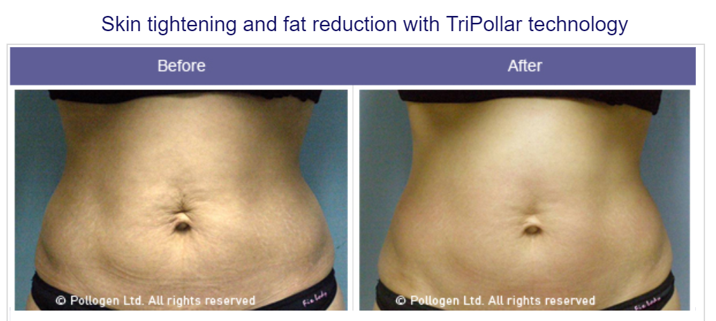 Skin tightening treatment planning